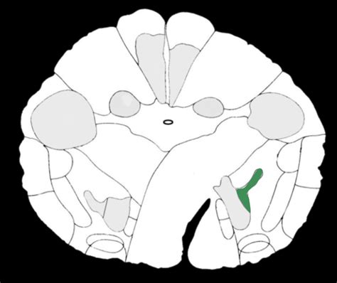 Image result for Contralateral Weakness