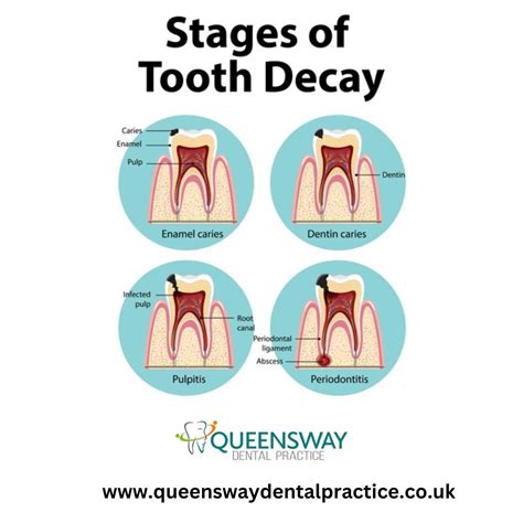 🦷 Protect Your Smile: Understanding the Stages of Tooth Decay! 🦷 Did you know that tooth decay ...