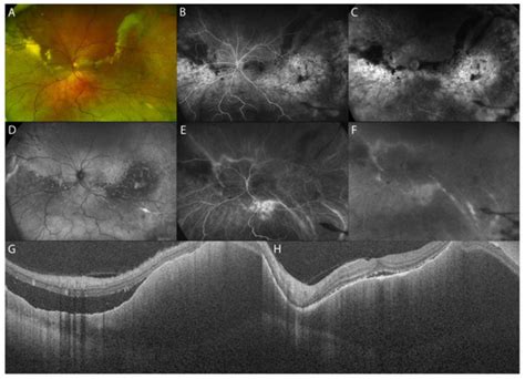 Diagnostics | Special Issue : Advances in Optical Coherence Tomography ...