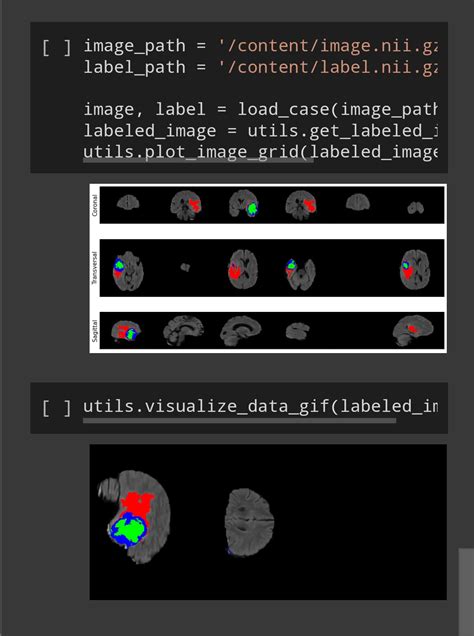 Image result for Brain Tumor Detection Using Machine Learning