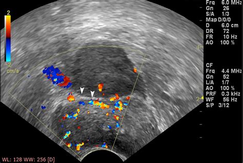 Space Of Retzius Ultrasound