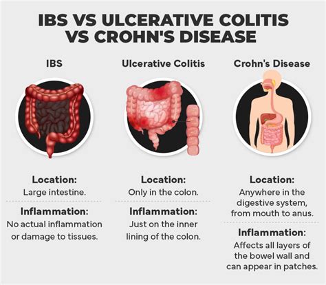Colitis Vs. Cancer 的图像结果