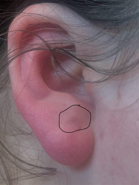 Earlobe Cyst for weeks : r/DermatologyQuestions
