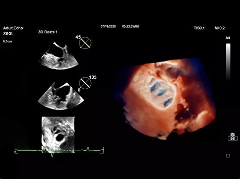 Philips - Live 3D TEE 3D ultrasound imaging