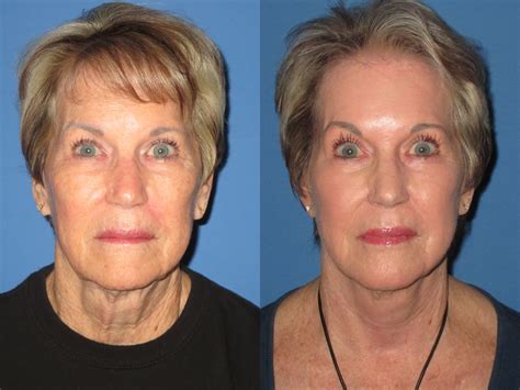 Facelift Before And After Photos | Elite Facial Plastic Surgery