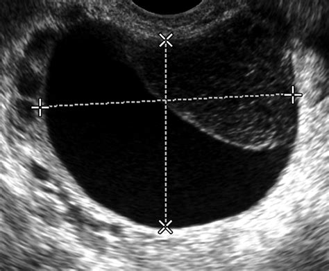 Ovarian Cyst And Cancer Ultrasound Ovarian Cystic Neoplasms