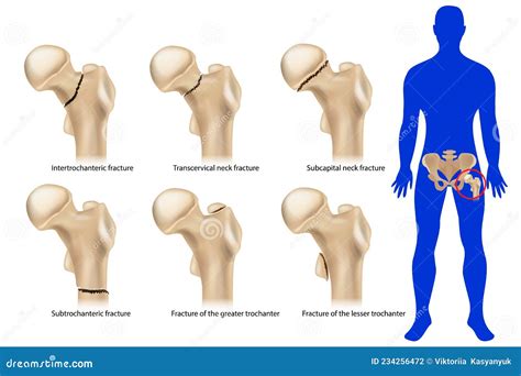 Femoral Neck Fracture. Types of Hip Fractures Stock Vector ...