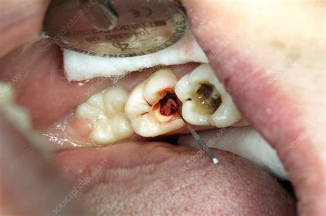 Difficult Tooth Root Extraction 的图像结果