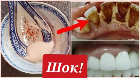 Желтые зубы у ребенка и взрослого: причины, методы отбеливания в ...