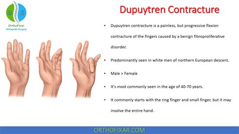 Dupuytren Contracture - Easy Explaned | OrthoFixar 2026