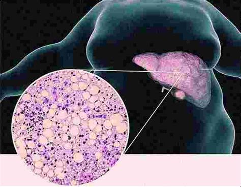 Best Nonalcoholic Fatty Liver Disease (NAFLD) - Hepatology - Liver ...