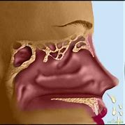 Image result for rhinopharyngitis