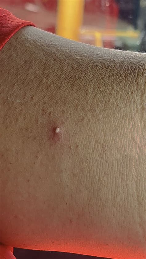 Small Pimple Pop for People Purple Nurples : r/popping