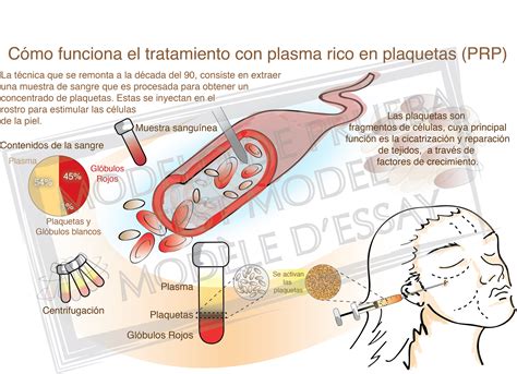 Graphique Science (Chile): Infografy for Platelet-rich plasma (PRP) in ...