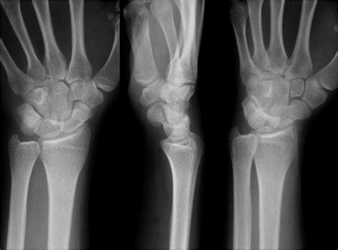 Carpal Bones Xray