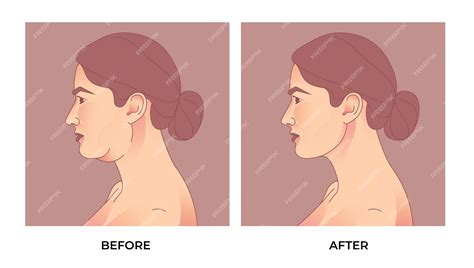 Premium Vector | Double chin liposuction. before and after brachioplasty, liposuction or plastic ...