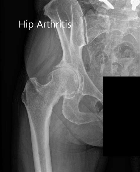 Osteoarthritis Hip X Ray