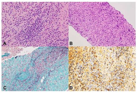19-Gauge Versus 22-Gauge Franseen Needles, Comparison of the ...