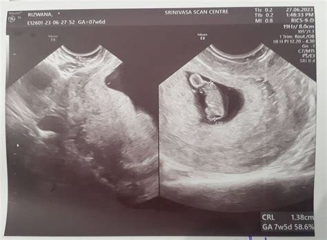 7weeks 5days transvaginal ultrasound scan. | BabyCenter