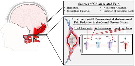 A Systematic Review of Non-Opioid Pain Management in Chiari Malformation (Type 1) Patients ...