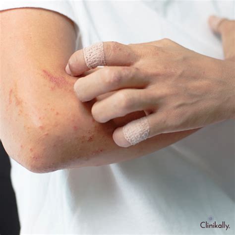 How Anxiety Medication Can Affect Your Skin | Clinikally