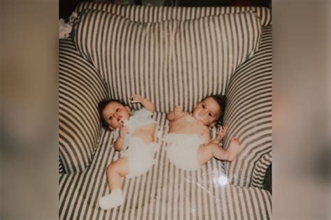 What Happens If a Conjoined Twin Dies - What Happens Iff