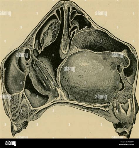 Nasal tumour hi-res stock photography and images - Alamy