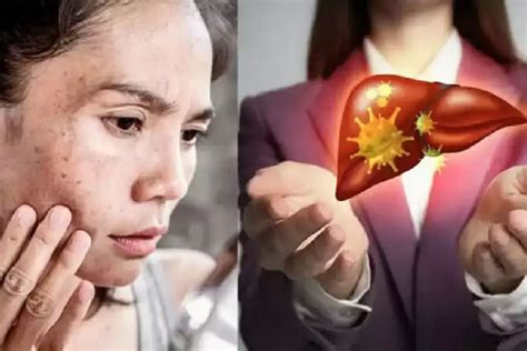 Liver Symptoms On Skin: Are you seeing dark spots on your face? They ...