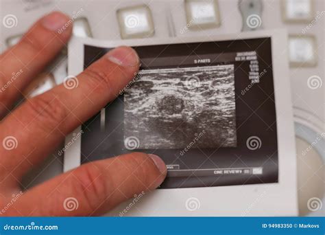 Ultrasound Photo - Metastatic Lymph Node in Breast Cancer Stock Photo - Image of doctor, healthy ...