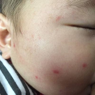 宝宝发烧脸上有小红点_白血病初期针孔小红点图片_微信公众号文章