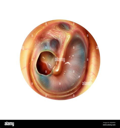 Ciprofloxacin Ear Drops Perforated Tympanic Membrane at Sherri Branch blog