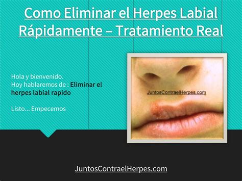 Eliminar Herpes Labial En Horas