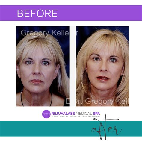 The Endoscopic Brow Lift Invented by Dr. Gregory Keller: A Game-Changer ...
