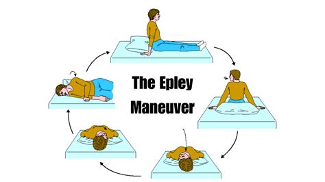 Vertigo Exercises Epley Maneuver Frontiers | Self Treatment Of