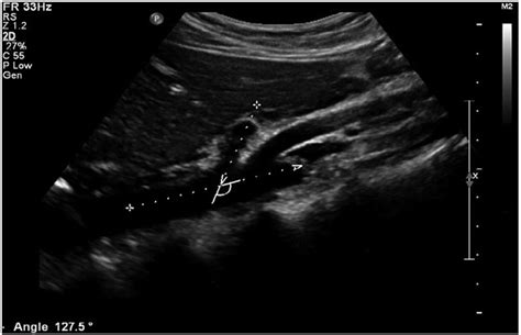 Real-time ultrasound: Key factor in identifying celiac artery ...