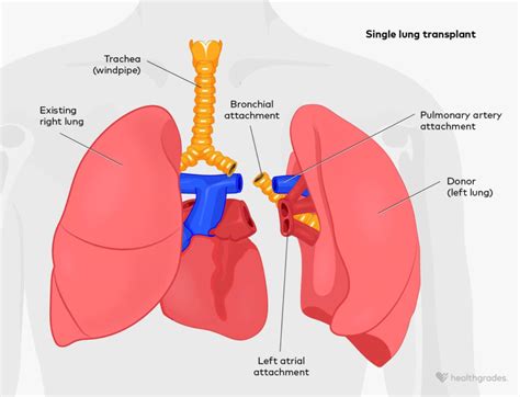 Lung Transplant: Surgical Details and What to Expect
