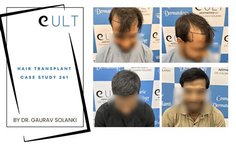 Hair Transplant Results 261 | Cult Aesthetics