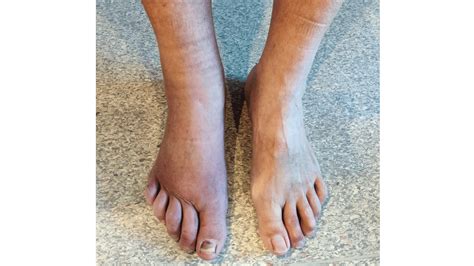 Acrodermatitis chronica atrophicans | Ugeskriftet.dk