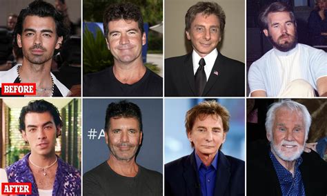 Male Celebrity Before And After Plastic Surgery