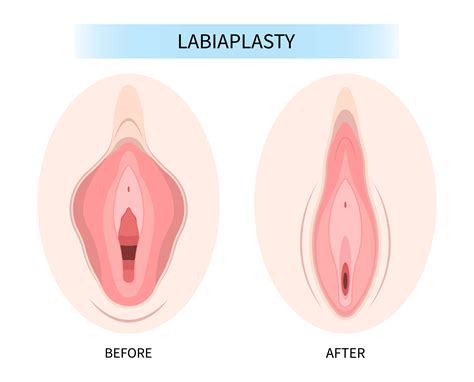 How To Take Better Photos For Labiaplasty Clinics
