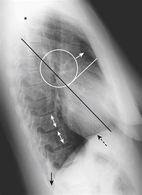 Image result for Poumon Normal Scanner