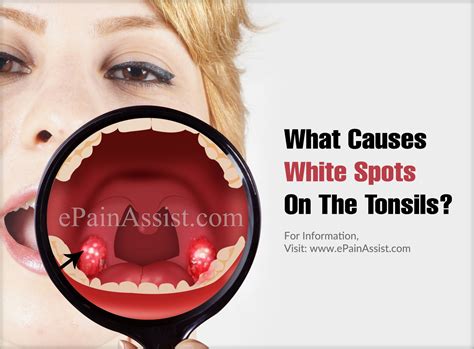 What Causes White Spots On The Tonsils & How To Manage It?