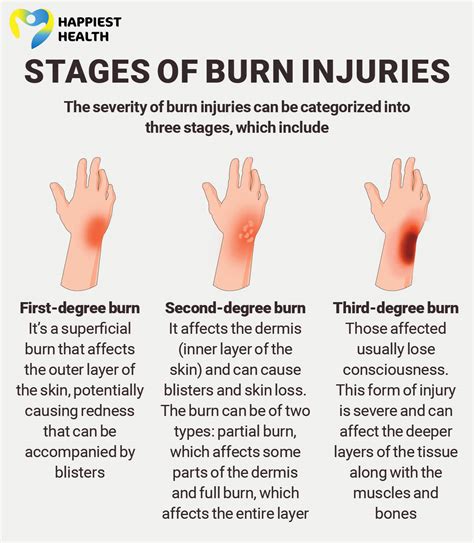 Third Degree Burns Treatment Types Of Burns And How To Treat Them