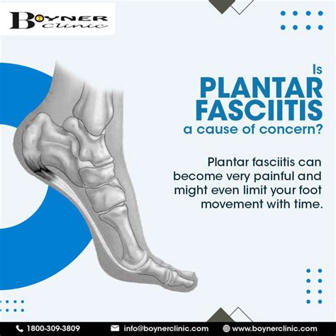 Treat Plantar Fasciitis with Custom Orthotics | Boyner Clinic