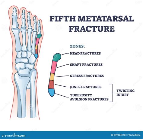 What Is A Spiral Fracture Of The Toe at Jaxon Burnett blog