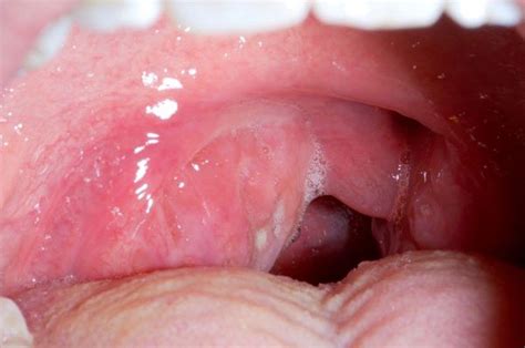 Tonsillar Cellulitis and Tonsillar Abscess - Ear, Nose, and Throat Disorders - MSD Manual ...