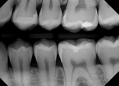 Bitewing Dental X Ray