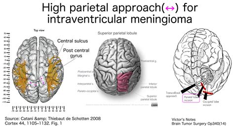 Superior Parietal Lobule Approach