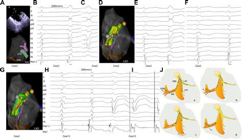 Electrocardiographic and electrophysiological characteristics of ventricular arrhythmias from ...