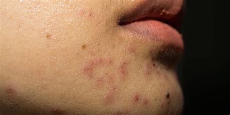 Image result for Exploding Face Zits